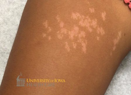 Curvilinear hypopigmented papules coalescing into a plaque on the thigh. (click images for higher resolution).